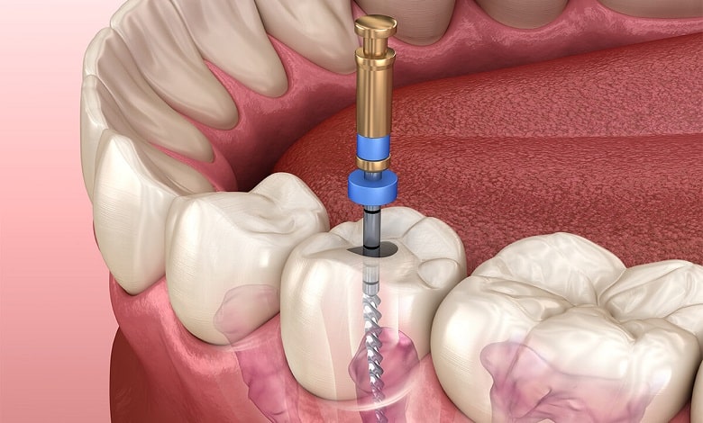 عصب کشی دندان توسط دکتر مریم حبیبی